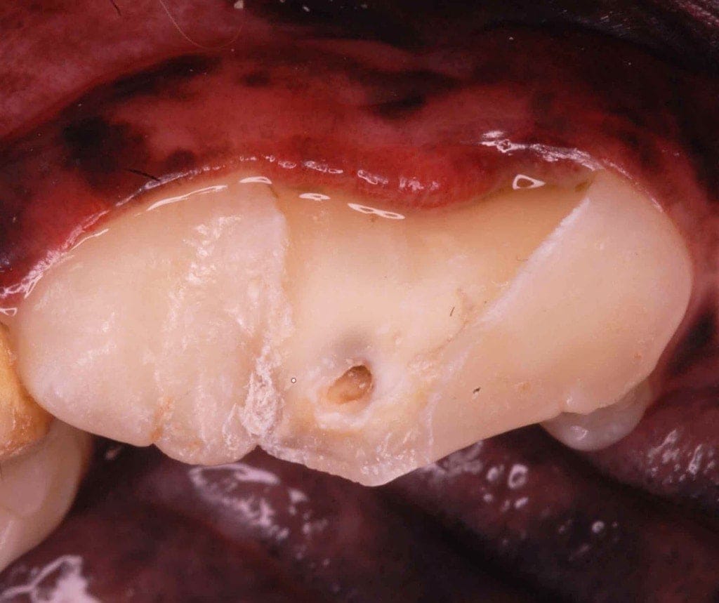 Slab fracture on dog tooth